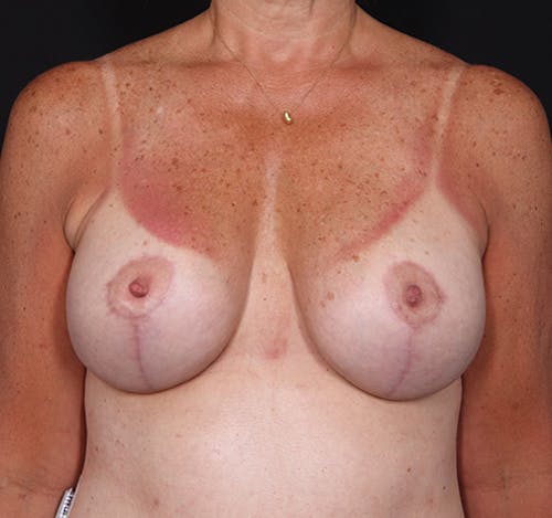 New Jersey Breast Lift (Mastopexy) Before & After Gallery - Patient ev3Qs6BuRR-oynbrj_byLQ - Image 2