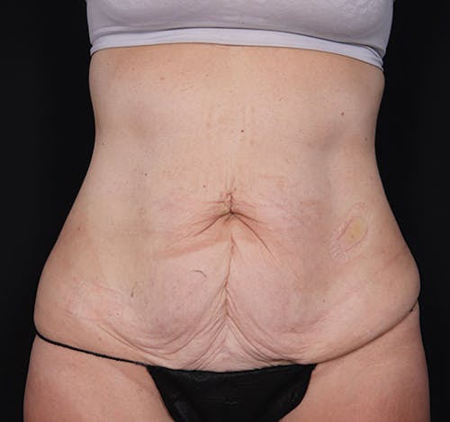 New Jersey Body Lift Before & After Gallery - Patient e2uSpYH0TLi2Q2zw7RON0A - Image 1