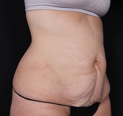 New Jersey Body Lift Before & After Gallery - Patient 137046 - Image 3