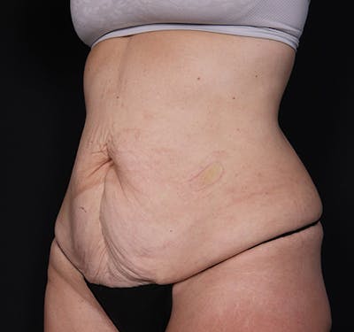 New Jersey Body Lift Before & After Gallery - Patient 137046 - Image 5
