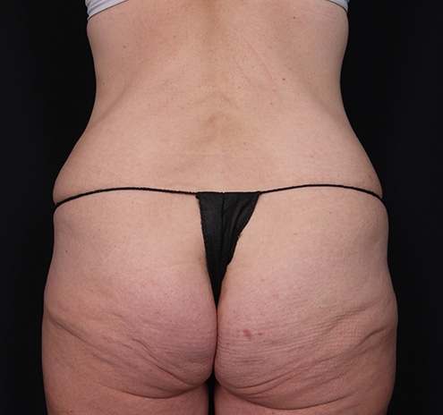 New Jersey Body Lift Before & After Gallery - Patient 137046 - Image 9