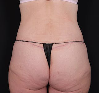 New Jersey Body Lift Before & After Gallery - Patient 137046 - Image 10