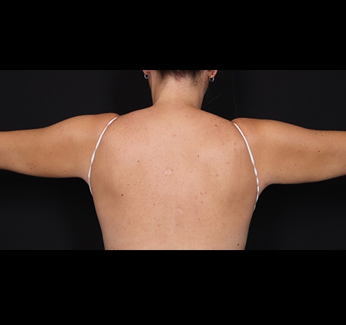 New Jersey Bodytite Before & After Gallery - Patient 401086 - Image 2