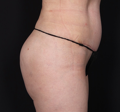 New Jersey Buttock/Hip Fat Grafting Before & After Gallery - Patient 254135 - Image 6