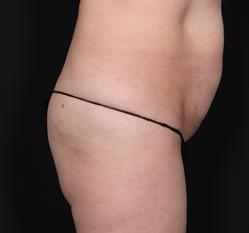New Jersey Buttock/Hip Fat Grafting Before & After Gallery - Patient 254135 - Image 5