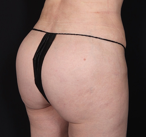 New Jersey Buttock/Hip Fat Grafting Before & After Gallery - Patient 254135 - Image 4