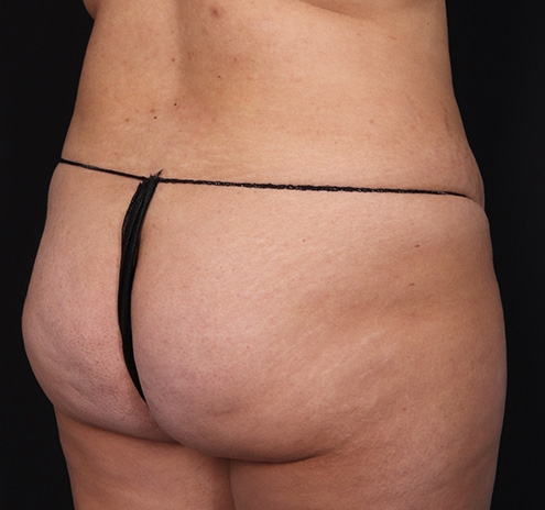 New Jersey Buttock/Hip Fat Grafting Before & After Gallery - Patient 102422 - Image 3