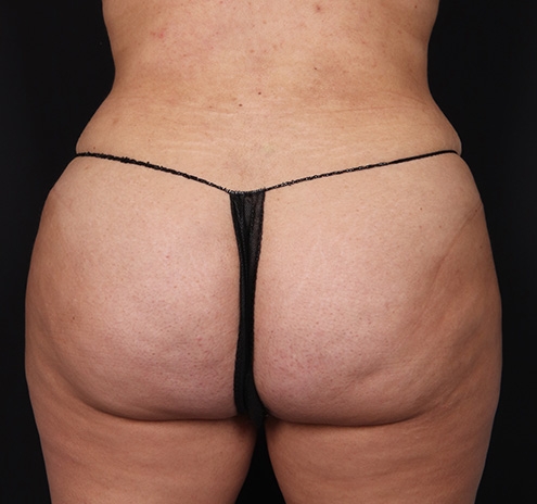 New Jersey Buttock/Hip Fat Grafting Before & After Gallery - Patient 102422 - Image 2