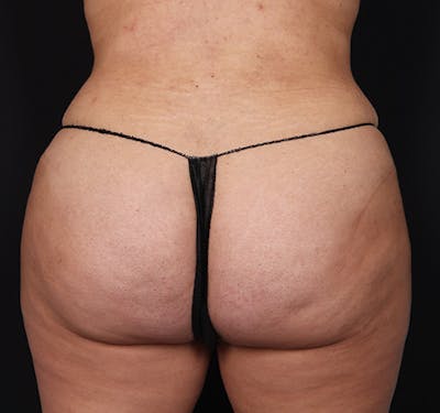 New Jersey Buttock/Hip Fat Grafting Before & After Gallery - Patient 102422 - Image 2