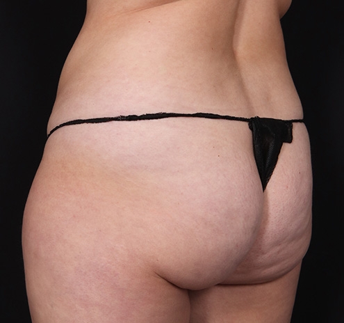 New Jersey Buttock/Hip Fat Grafting Before & After Gallery - Patient 135538 - Image 5