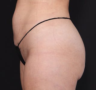 New Jersey Buttock/Hip Fat Grafting Before & After Gallery - Patient 135538 - Image 8