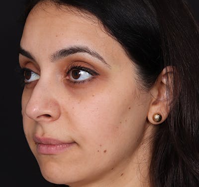 New Jersey Non-Surgical Rhinoplasty Before & After Gallery - Patient 130225 - Image 3