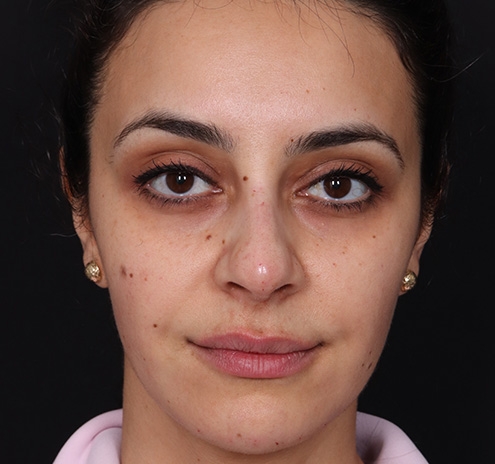 New Jersey Non-Surgical Rhinoplasty Before & After Gallery - Patient 130225 - Image 2