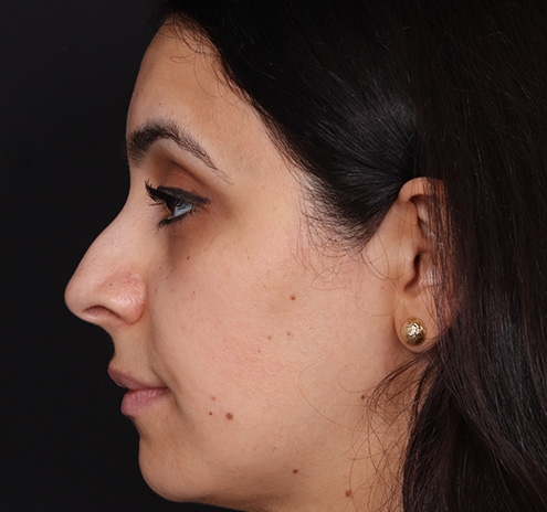 New Jersey Non-Surgical Rhinoplasty Before & After Gallery - Patient 130225 - Image 5