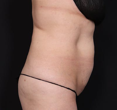 New Jersey Tummy Tuck Before & After Gallery - Patient 331809 - Image 5