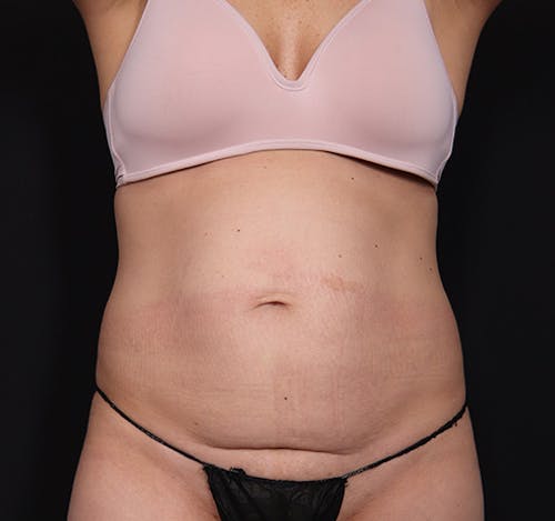 New Jersey Tummy Tuck Before & After Gallery - Patient fDU4m9XdRyeRrEzVJB4nEw - Image 1
