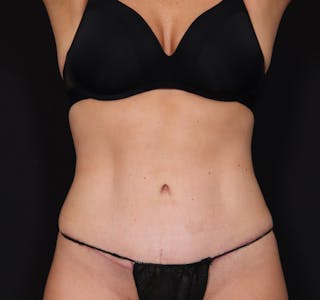 New Jersey Tummy Tuck Before & After Gallery - Patient 378663 - Image 2