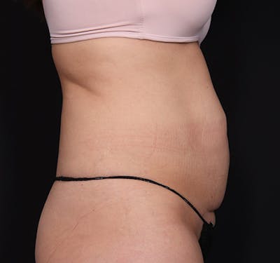 New Jersey Tummy Tuck Before & After Gallery - Patient 378663 - Image 5