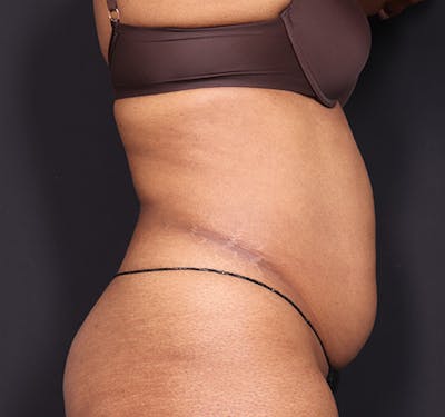 New Jersey Tummy Tuck Before & After Gallery - Patient 219745 - Image 5