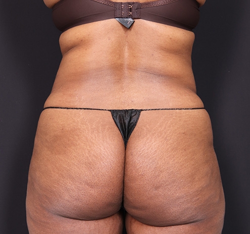 New Jersey Tummy Tuck Before & After Gallery - Patient 219745 - Image 9