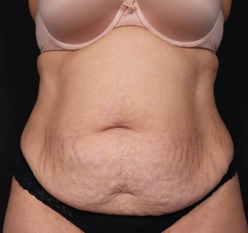 New Jersey Tummy Tuck Before & After Gallery - Patient YTtkp7vvRKWjbRv5uRd_og - Image 1
