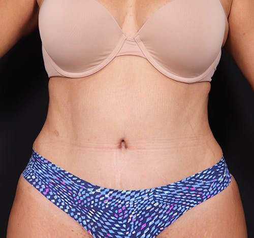 New Jersey Tummy Tuck Before & After Gallery - Patient YTtkp7vvRKWjbRv5uRd_og - Image 2