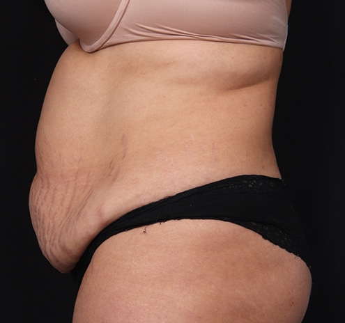 New Jersey Tummy Tuck Before & After Gallery - Patient 195104 - Image 7