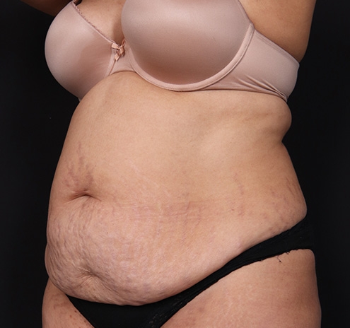 New Jersey Tummy Tuck Before & After Gallery - Patient 195104 - Image 5