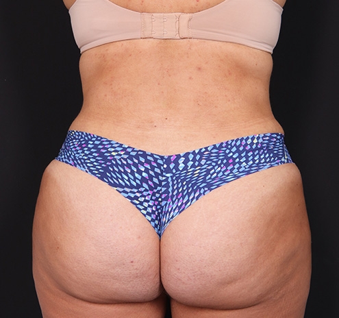 New Jersey Tummy Tuck Before & After Gallery - Patient 195104 - Image 10