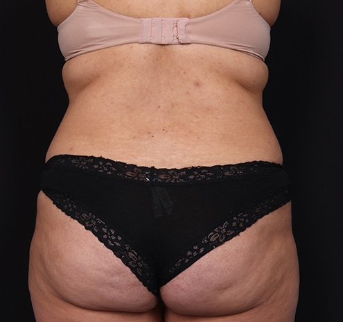 New Jersey Tummy Tuck Before & After Gallery - Patient 195104 - Image 9