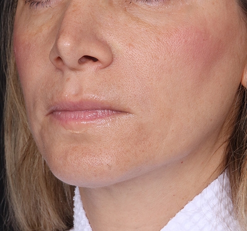 New Jersey Fillers Before & After Gallery - Patient 174173 - Image 3