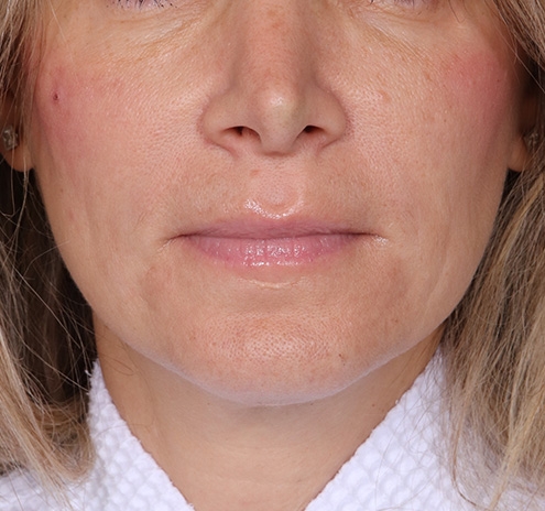 New Jersey Fillers Before & After Gallery - Patient 174173 - Image 2