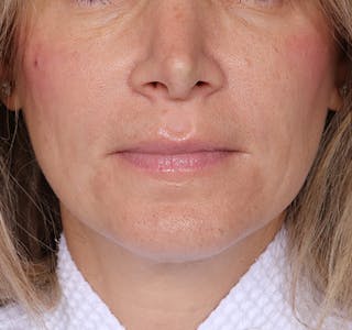 New Jersey Fillers Before & After Gallery - Patient 174173 - Image 2