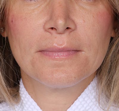 New Jersey Fillers Before & After Gallery - Patient 174173 - Image 2