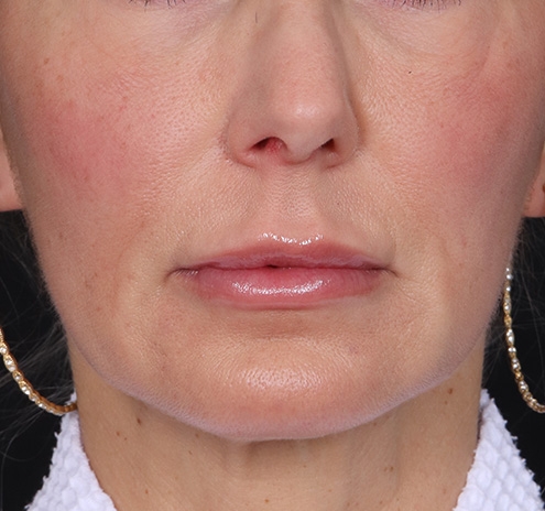 New Jersey Fillers Before & After Gallery - Patient 271487 - Image 2
