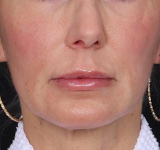 New Jersey Fillers Before & After Gallery - Patient 271487 - Image 2
