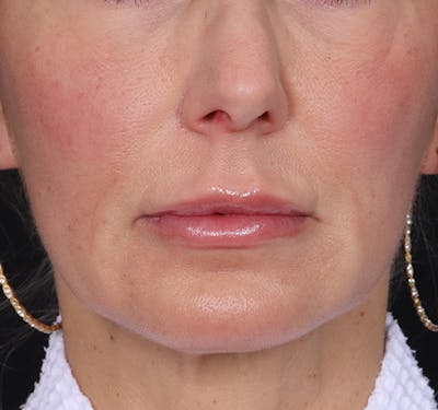 New Jersey Fillers Before & After Gallery - Patient 271487 - Image 2