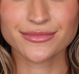 New Jersey Fillers Before & After Gallery - Patient 266124 - Image 2