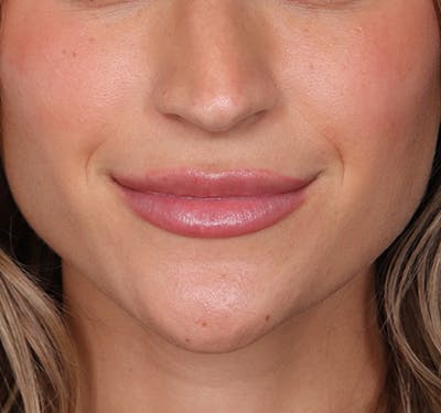 New Jersey Fillers Before & After Gallery - Patient 266124 - Image 2