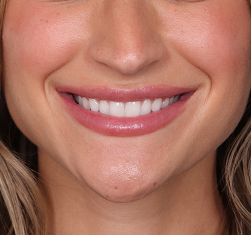 New Jersey Fillers Before & After Gallery - Patient 266124 - Image 4