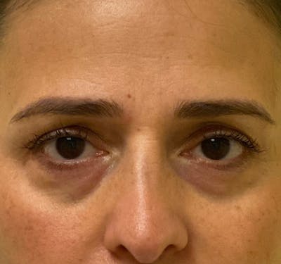 New Jersey Fillers Before & After Gallery - Patient 199072 - Image 1