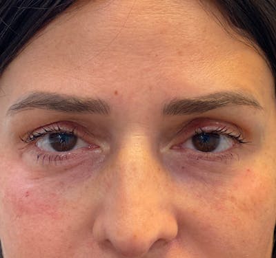 New Jersey Fillers Before & After Gallery - Patient 199072 - Image 2