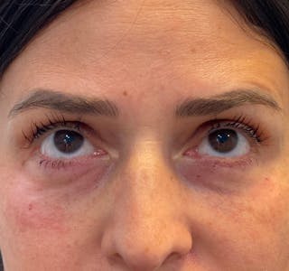 New Jersey Fillers Before & After Gallery - Patient 199072 - Image 4