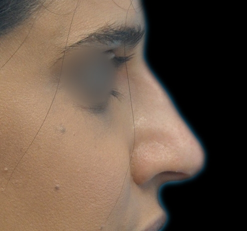 New Jersey Non-Surgical Rhinoplasty Before & After Gallery - Patient 383758 - Image 2
