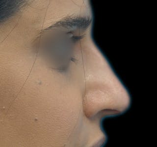 New Jersey Non-Surgical Rhinoplasty Before & After Gallery - Patient 383758 - Image 2