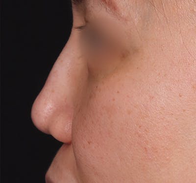 New Jersey Non-Surgical Rhinoplasty Before & After Gallery - Patient 392492 - Image 3