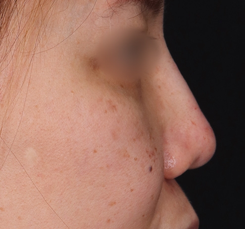 New Jersey Non-Surgical Rhinoplasty Before & After Gallery - Patient 392492 - Image 2