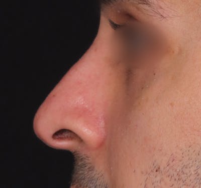 New Jersey Non-Surgical Rhinoplasty Before & After Gallery - Patient 264265 - Image 2