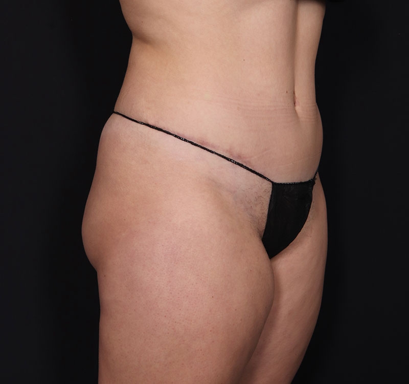 New Jersey Monsplasty Before & After Gallery - Patient 241969 - Image 10
