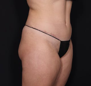 New Jersey Monsplasty Before & After Gallery - Patient 241969 - Image 10